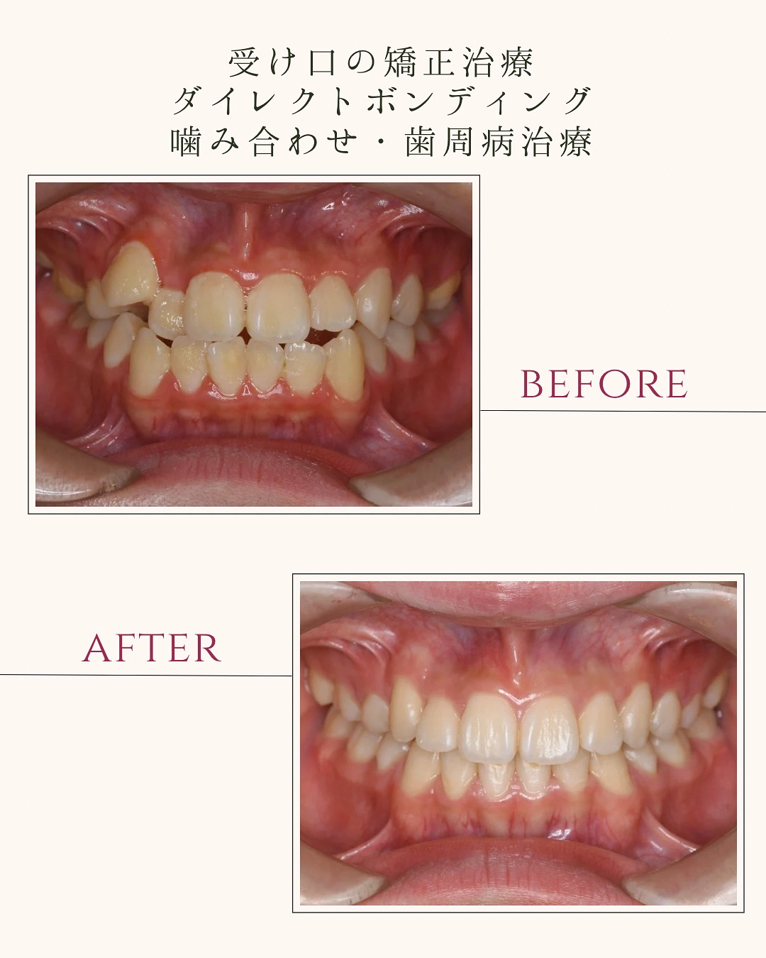 受け口の矯正治療 ダイレクトボンディング 噛み合わせ・歯周病治療