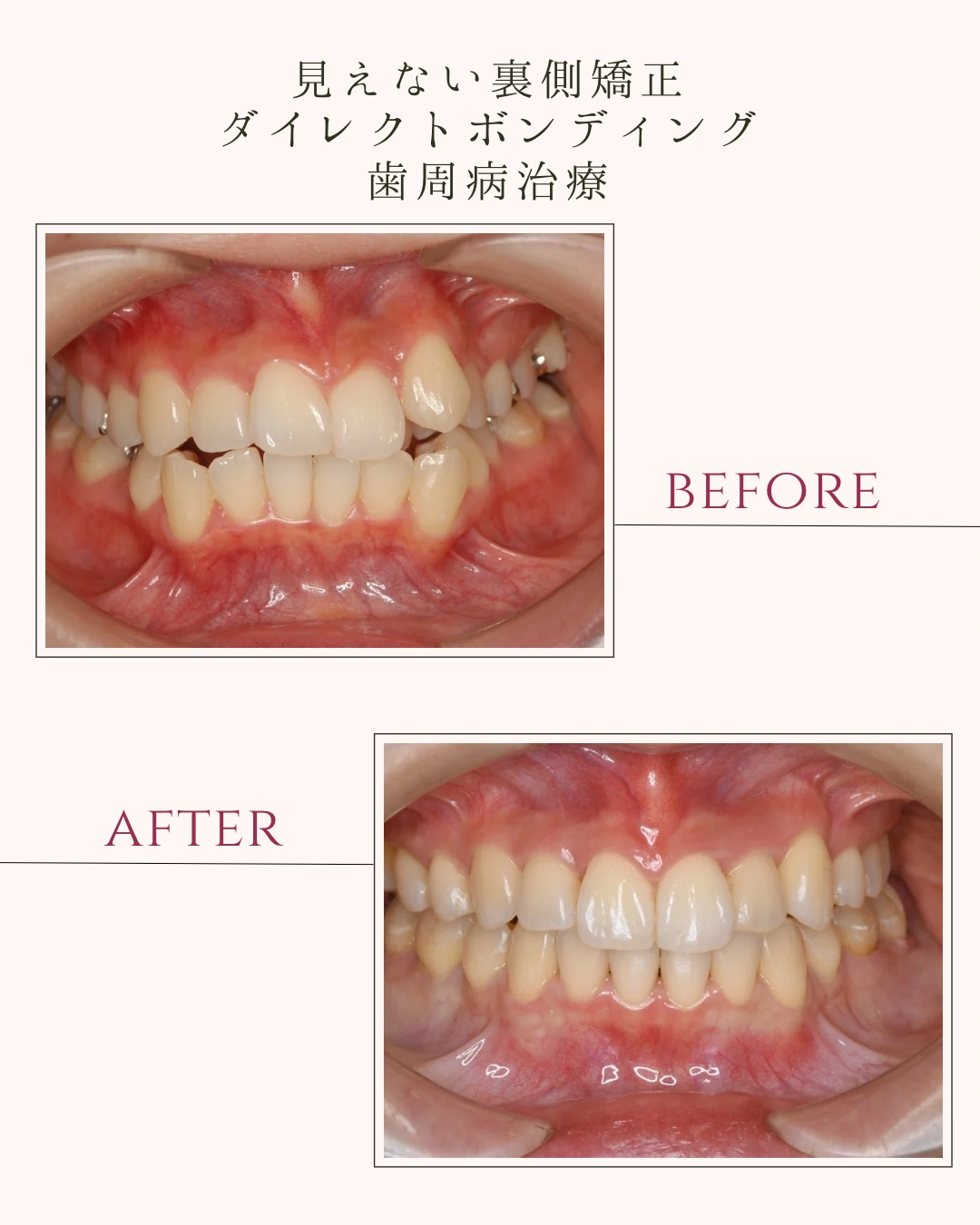 見えない裏側矯正 ダイレクトボンディング 歯周病治療